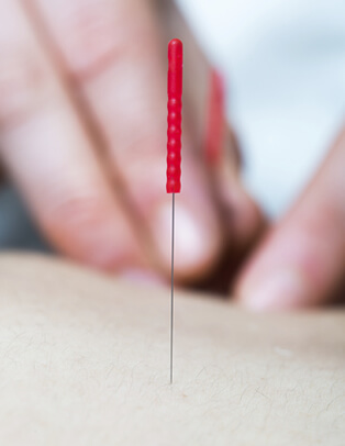 Acupuncture and Trigger Point Therapy